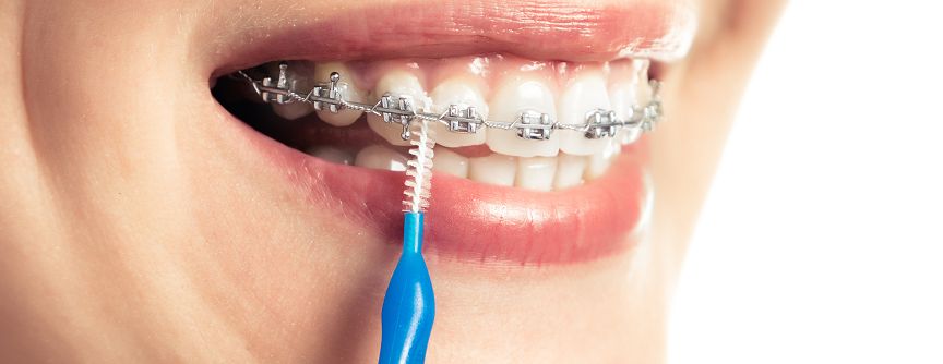 Vệ sinh răng miệng khi niềng